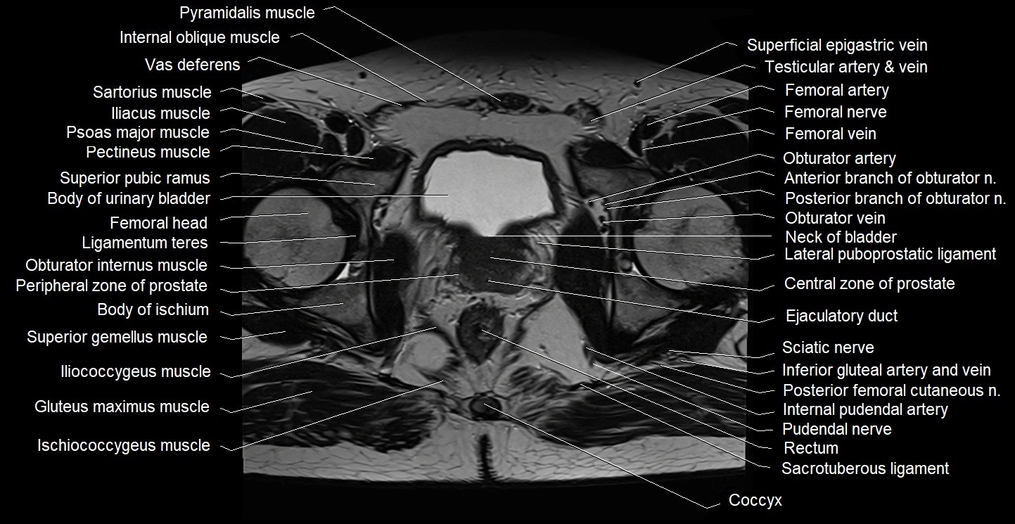 Male pelvis axial cross sectional anatomy image 29.webp